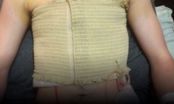 Skandal në SHBA, mjekët kryejnë mastektomi edhe tek vajzat 13-vjeçare