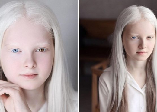 Kjo është vajza me një bukuri unike që ka albinizmi