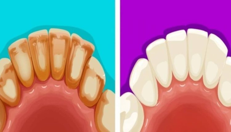 I thoni menjëherë “lamtumirë” dentistit, vendosni sodë buke me kripë te dhëmbët