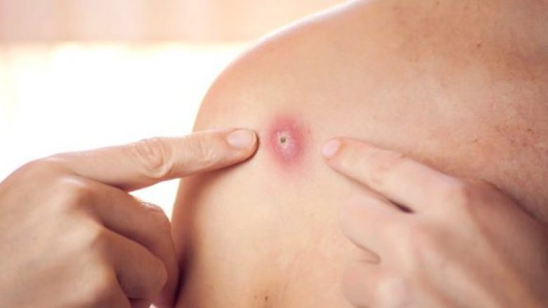Ministria e Shëndetësisë në Maqedoni: Nuk ka asnjë rast të konfirmuar me “linë e majmunëve”